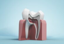 Resezione radicolare, quando è possibile salvare il dente Resezione radicolare