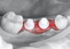 Impianti in zirconia, il primo anno è decisivo Impianti in zirconia