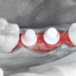 Impianti in zirconia, il primo anno è decisivo Impianti in zirconia