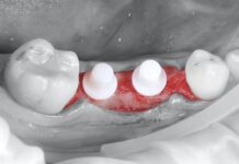 Impianti in zirconia, il primo anno è decisivo Impianti in zirconia