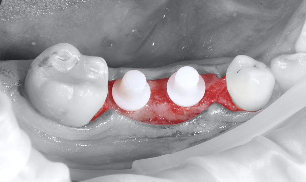 Zirconia,Dental,Implants,,Biocompatible,Metal,Free Impianti in zirconia