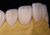 Usura dentale, la riabilitazione passa dalla stampa 3D usura dentale