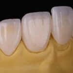 Usura dentale, la riabilitazione passa dalla stampa 3D usura dentale