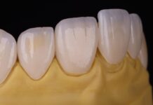 Usura dentale, la riabilitazione passa dalla stampa 3D usura dentale