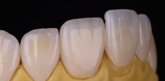 Usura dentale, la riabilitazione passa dalla stampa 3D usura dentale
