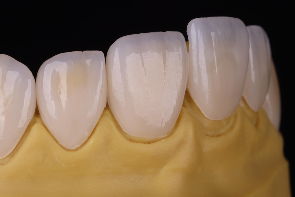 Ceramic,Veneers,Aesthetic,Dental,3d,Printing usura dentale
