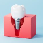 Atrofia alveolare e rischio di fallimento implantare Atrofia alveolare