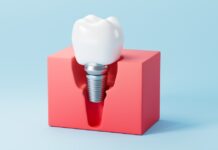 Atrofia alveolare e rischio di fallimento implantare Atrofia alveolare