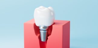 Atrofia alveolare e rischio di fallimento implantare Atrofia alveolare