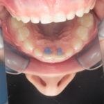 Turbo bite anteriore e dimensione verticale in dentizione decidua: caso clinico Turbo bite anteriore
