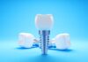 Impianti dentali, cosa succede dopo 25 anni? Impianti dentali