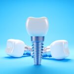 Impianti dentali, cosa succede dopo 25 anni? Impianti dentali