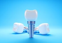 Impianti dentali, cosa succede dopo 25 anni? Impianti dentali