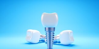Impianti dentali, cosa succede dopo 25 anni? Impianti dentali