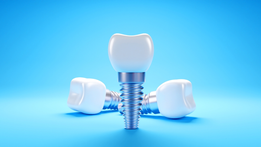 Impianti dentali