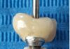 Manicotto di guarigione e peri-implantite: è possibile riscrivere il destino degli impianti considerati persi? Manicotto di guarigione