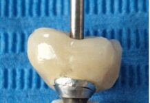 Manicotto di guarigione e peri-implantite: è possibile riscrivere il destino degli impianti considerati persi? Manicotto di guarigione