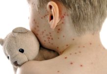 Morbillo e rosolia, i dati al 31 dicembre 2025