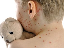 Morbillo e rosolia, i dati al 31 dicembre 2025