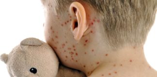 Morbillo e rosolia, i dati al 31 dicembre 2025