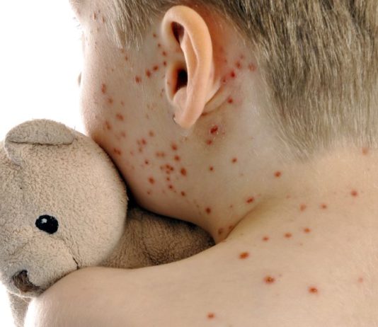 Morbillo e rosolia, i dati al 31 dicembre 2025