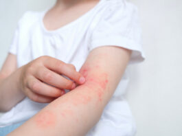 Impatto globale, regionale e nazionale della dermatite atopica