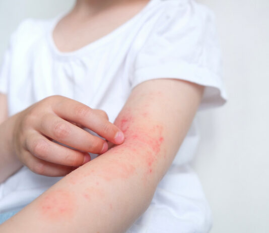 Impatto globale, regionale e nazionale della dermatite atopica