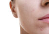 Fototermolisi selettiva per il trattamento dell’acne volgare