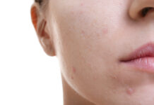 Fototermolisi selettiva per il trattamento dell’acne volgare