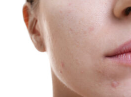 Fototermolisi selettiva per il trattamento dell’acne volgare