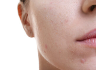 Fototermolisi selettiva per il trattamento dell’acne volgare