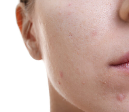 Fototermolisi selettiva per il trattamento dell’acne volgare