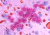Leucemia pediatrica, dall’AI un aiuto terapeutico per le forme T-ALL