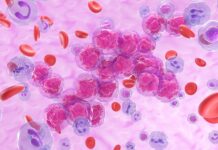 Leucemia pediatrica, dall’AI un aiuto terapeutico per le forme T-ALL