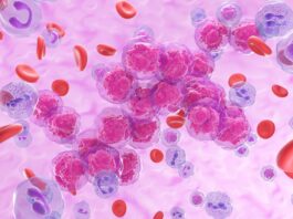 Leucemia pediatrica, dall’AI un aiuto terapeutico per le forme T-ALL
