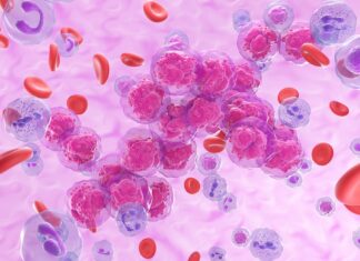 Leucemia pediatrica, dall’AI un aiuto terapeutico per le forme T-ALL