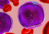 Leucemia linfoblastica acuta, efficacia dell’immunoterapia
