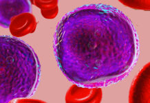 Leucemia linfoblastica acuta, efficacia dall’immunoterapia