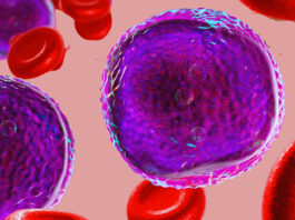 Leucemia linfoblastica acuta, efficacia dell’immunoterapia