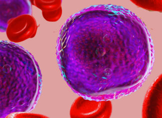 Leucemia linfoblastica acuta, efficacia dell’immunoterapia