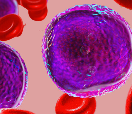 Leucemia linfoblastica acuta, efficacia dell’immunoterapia