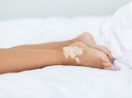 Vitiligine: saperla riconoscere e differenziare