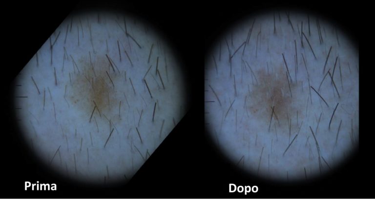 Un complesso naturale contro la caduta dei capelli