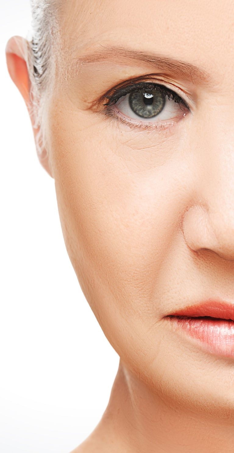 Efficacia di microaghi ad auto-dissoluzione e loro applicazione come anti-rughe