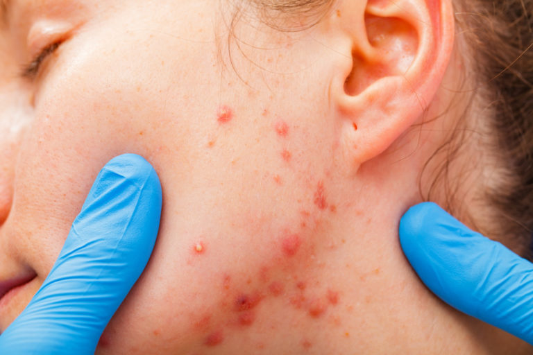 Uso degli acidi organici in caso di acne e macchie della pelle
