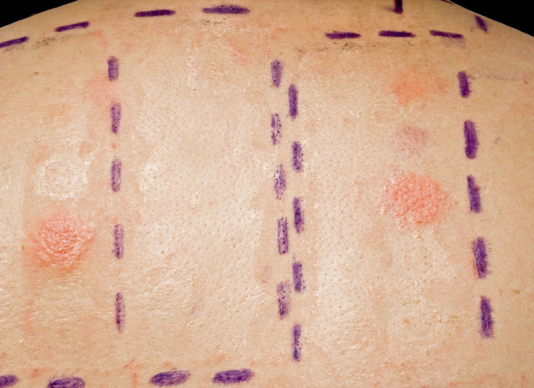 Patch Test nella valutazione della sospetta dermatite facciale