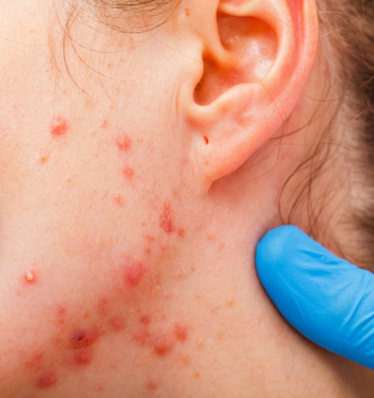 Retinoidi in combinazione con acido salicilico per il trattamento dell’acne