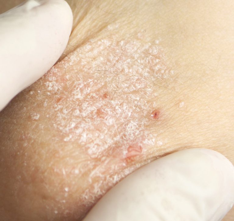 Dermatite atopica e cosmetici