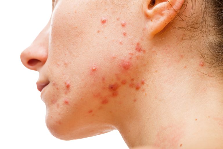 Acne, nuovi peptidi antimicrobici progettati mediante deep learning