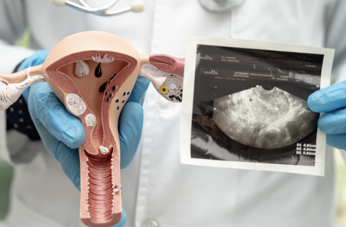 sindrome dell'ovaio policistico